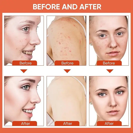 Mooyam Acne Face Cream (Original) - 07BM