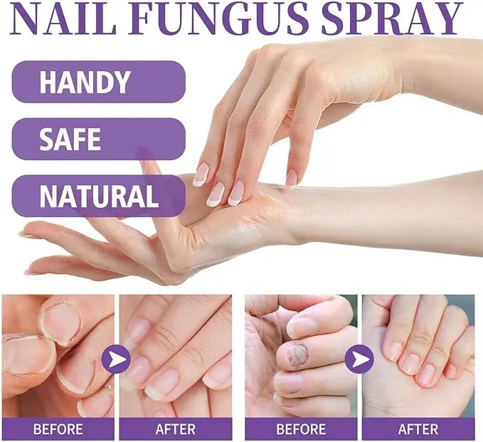 Nail Fungus Spray Original - 07BM